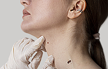 Комплексное удаление новообразований -25%