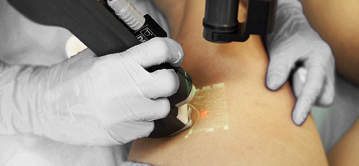 КЛаКС (CLaCS) – Крио Лазерная Крио Склеротерапия