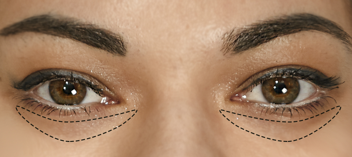 Пластика век Киев (блефаропластика) цена