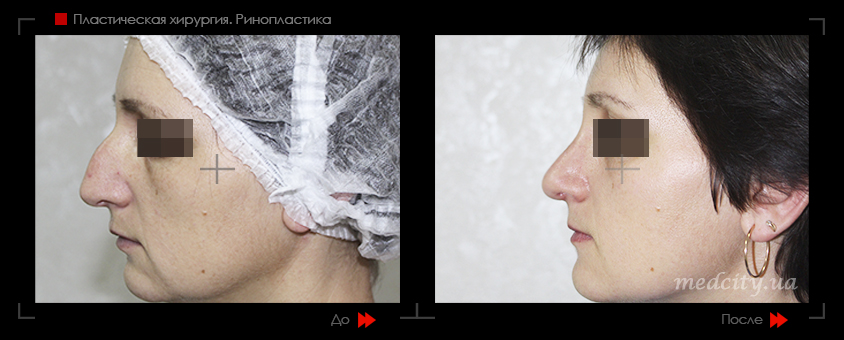 Нос с горбинкой. Когда нужна пластика?