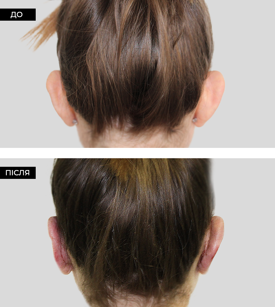 Лопоухость