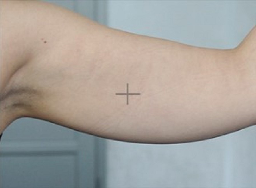 Брахиопластика (подтяжка кожи рук)