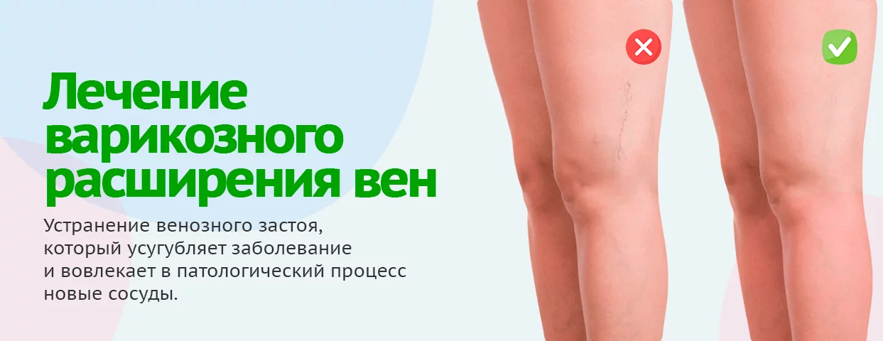 Самый эффективный метод лечения варикоза