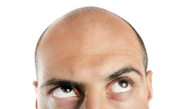 Облысение у мужчин