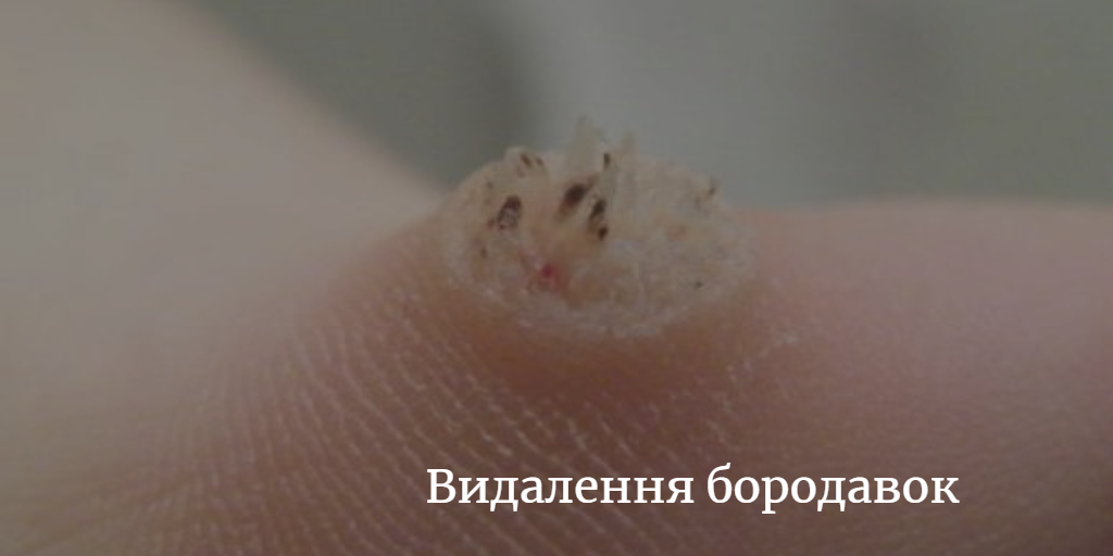 Видалення бородавок Київ