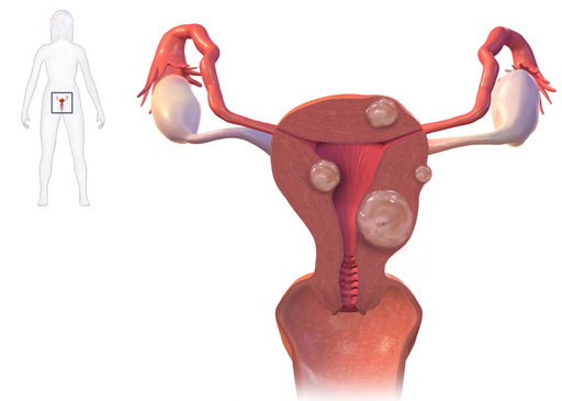 Фибромиома матки