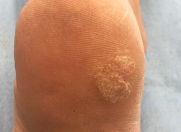 Как избавиться от сухих мозолей