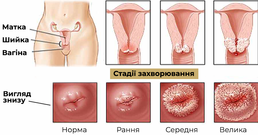 Методы лечения эрозии шейки матки для нерожавших