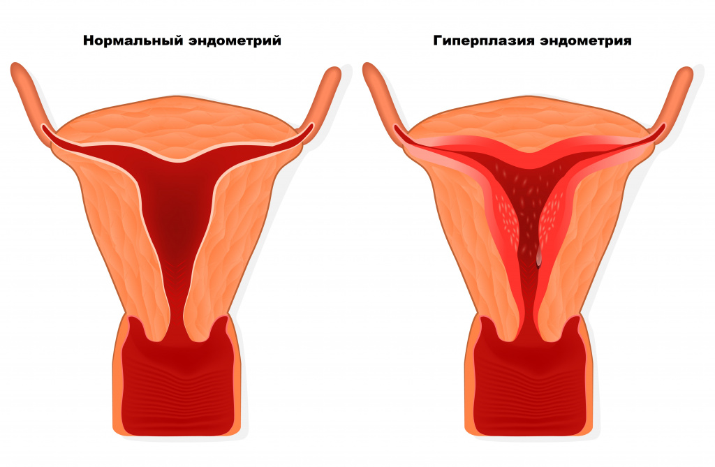 Гиперплазия эндометрия: симптомы, причины и методы лечения