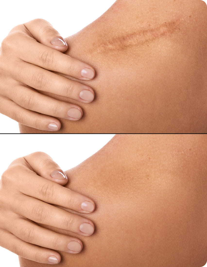 Келоидный рубец и способы избавления