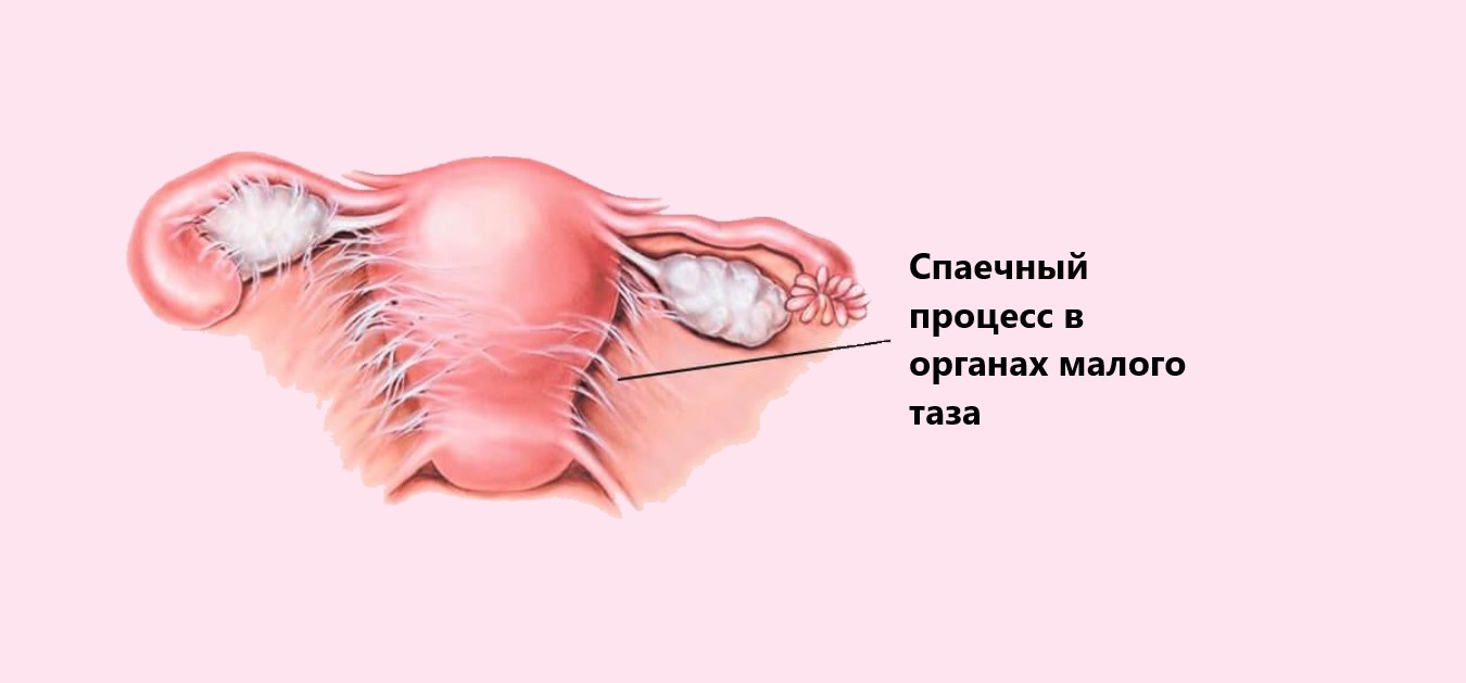 Спаечный процесс в малом тазу