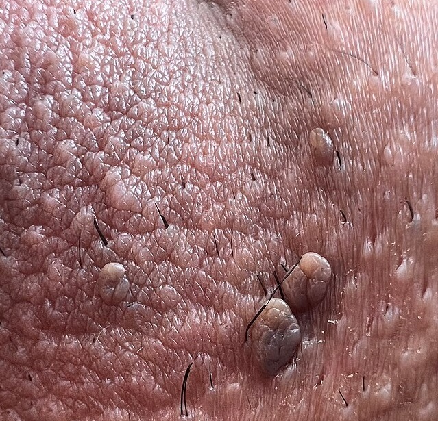 Вирус папилломы человека (ВПЧ)