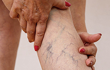 Discounts on surgical removal of varicose veins