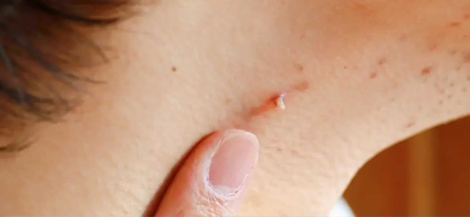 Лечение нитевидных папиллом