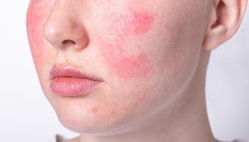 Красные пятна на лице