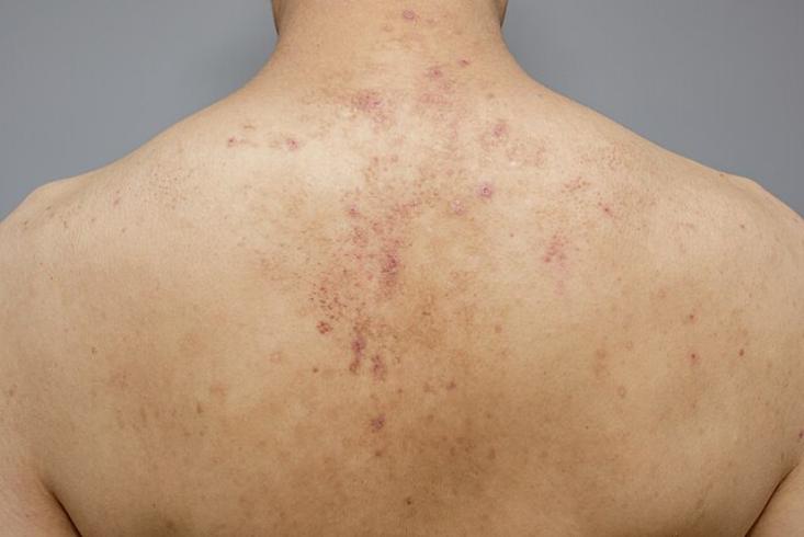 Лечение кератоза