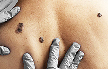 Discounts on comprehensive removal of neoplasms.