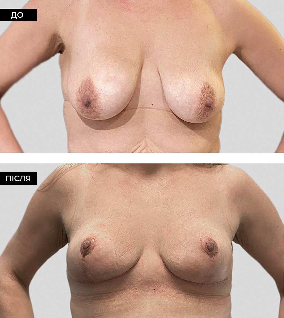 Подтяжка груди после родов