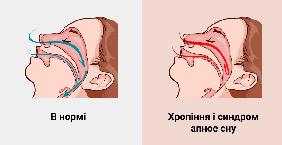 Как избавиться от храпа и почему это стоит сделать