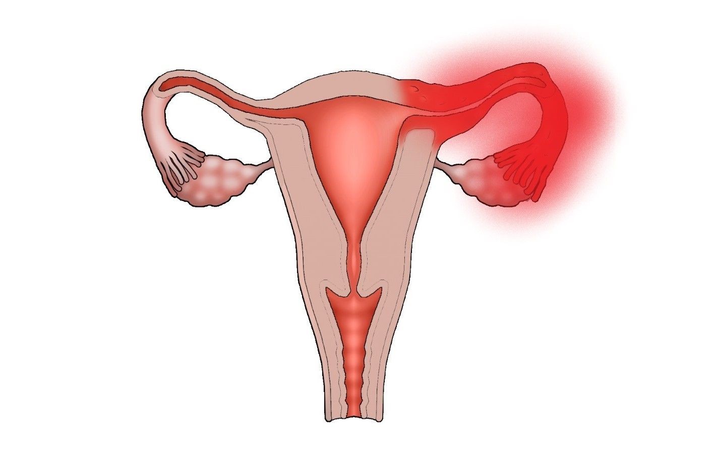 Воспаление придатков у женщин