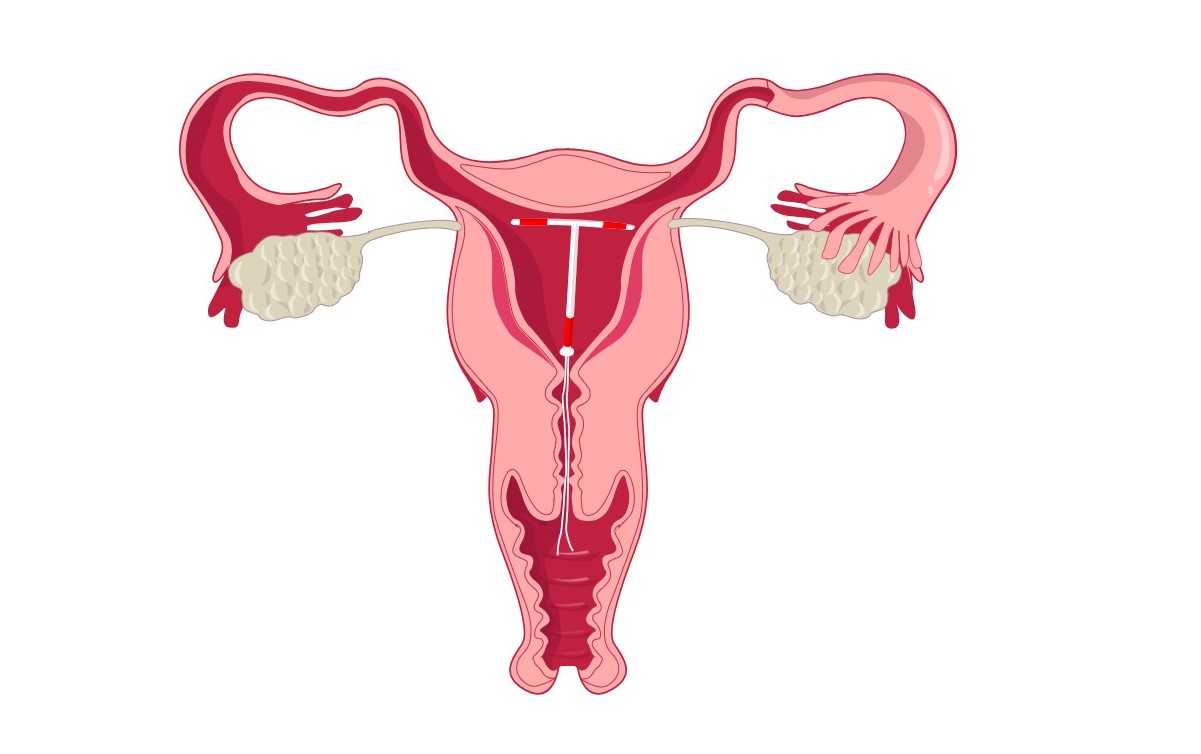 Внутриматочная спираль