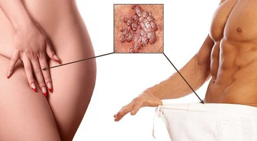 Почему появляются папилломы на гениталиях и как от них избавиться?