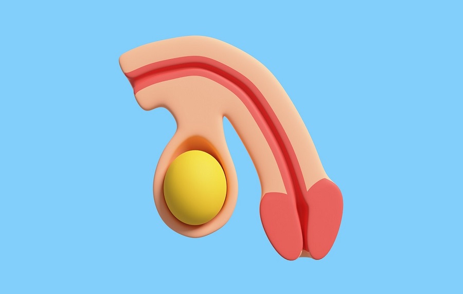 Фаллопластика