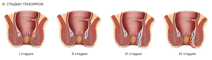 стадии геморроя рус.png