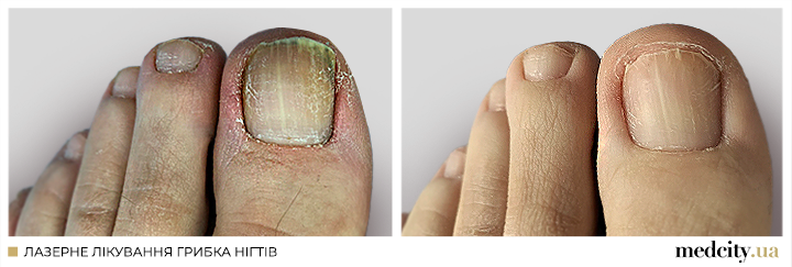 Грибок нігтів 1 укр.png