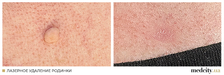 родимка2 рос.png родимка2 рос.png