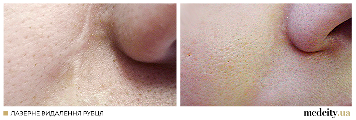 рубці 2 укр.png