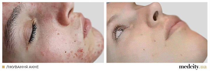 акне 2 укр.png