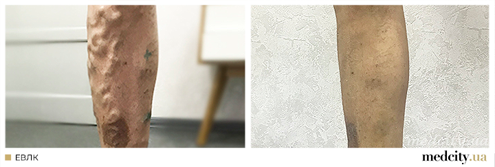 ЕВЛК3.png ЕВЛК3.png