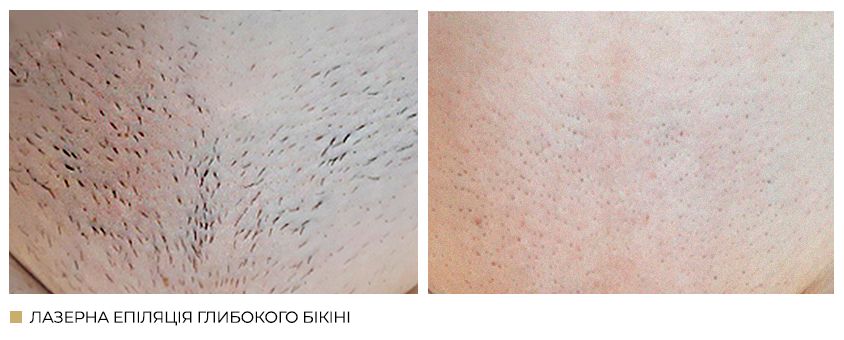 Лазерна епіляція