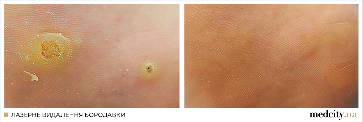 бородавка3 УКР.png бородавка3 УКР.png