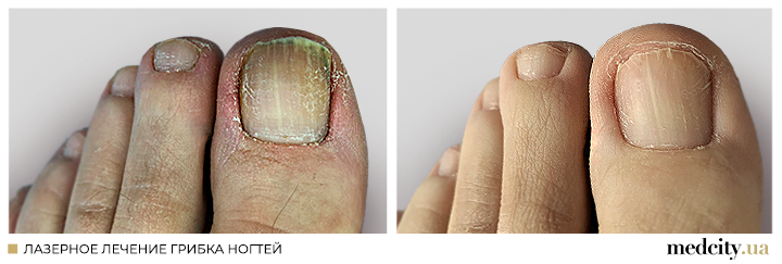 Грибок нігтів 1 рос.png