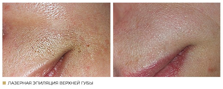 Лазерная эпиляция