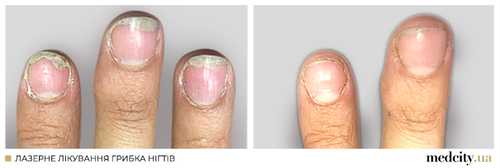 Грибок нігтів 2 укр.png