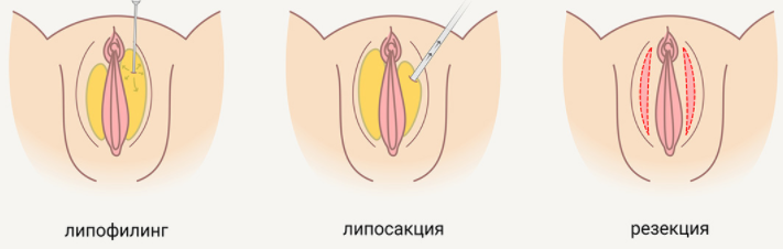 Липофилинг половых губ