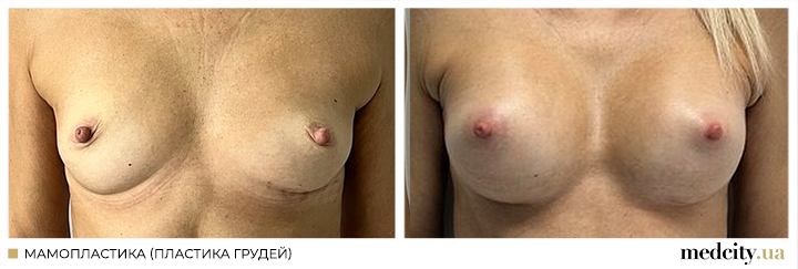 Мамопластика3.png
