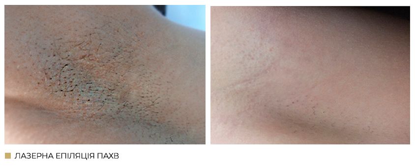 Лазерна епіляція