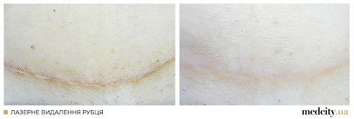 рубці 1 укр.png рубці 1 укр.png