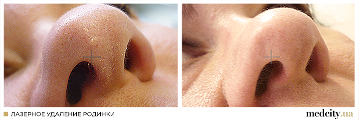 родимка3 рос.png родимка3 рос.png