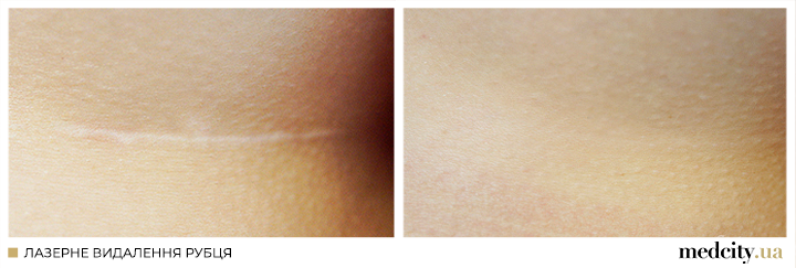 рубці 6 укр.png