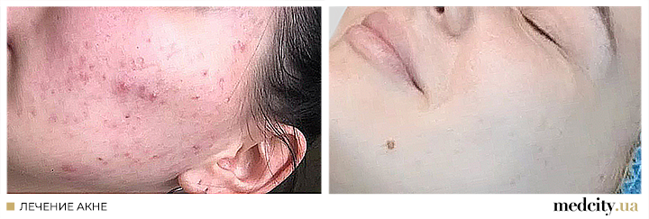 акне 2 рос.png