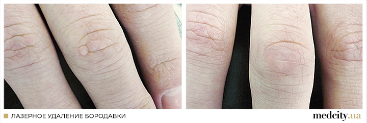 бородавка1 РОС.png бородавка1 РОС.png