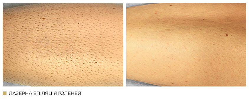 Лазерна епіляція