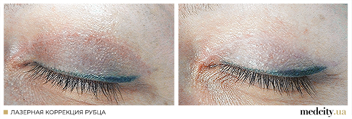 рубці 3 рос.png рубці 3 рос.png