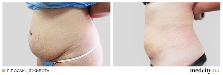 ліпо-живота-1.png ліпо-живота-1.png