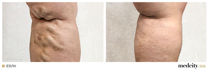 ЕВЛК2.png ЕВЛК2.png